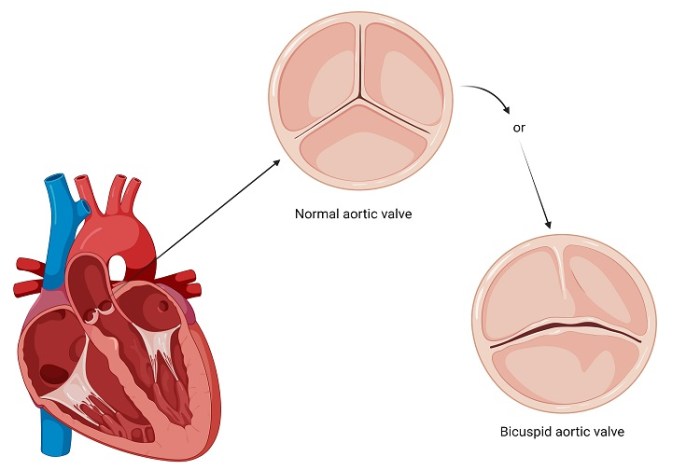 Valve aortic bicuspid heart left aorta blood ventricle congenital connects